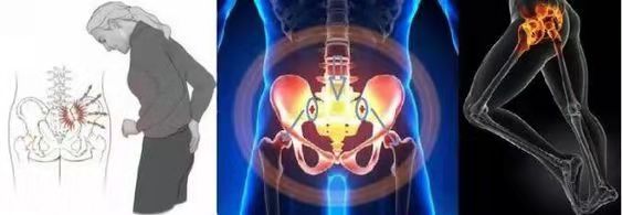 腰疼骶髂关节疼屁股疼,腰痛胯骨侧面痛屁股疼怎么回事