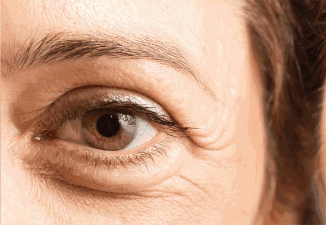 先改善细纹还是先修复抗衰,眼部显老怎么做抗衰