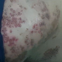 带状疱疹发展过程是怎么样的,带状疱疹怎么发生的