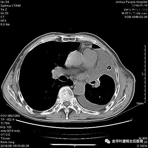 手术引起乳糜胸,有没有做了肺结节手术后是误诊的