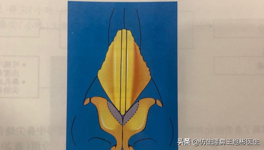 鼻头部位整形,鼻头圆钝高鼻梁整形案例