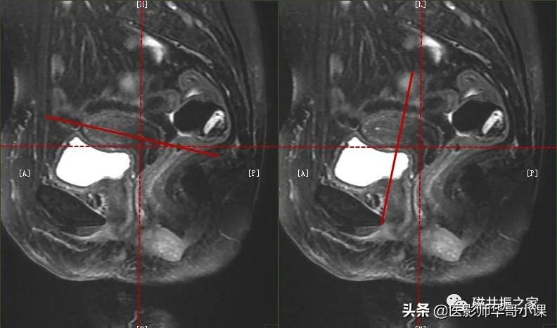 「精品课件」带大家看看，磁共振子宫MRI要如何扫描？