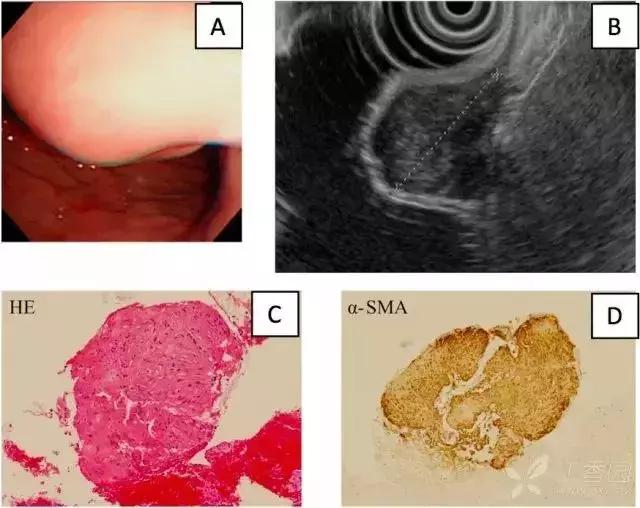 胃镜胃粘膜下隆起严重吗,胃镜提示粘膜下隆起病变