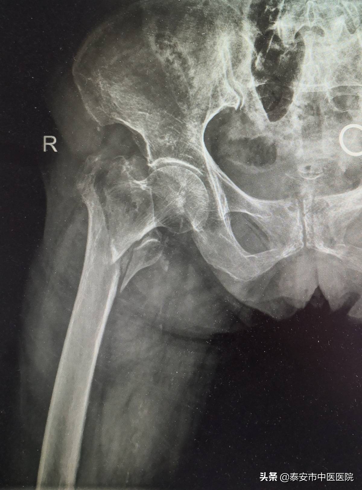 勇担健康新使命续写“骨伤”新担当——记*安泰**市中医医院（*安泰**市骨伤医院）创伤骨科、手足外科