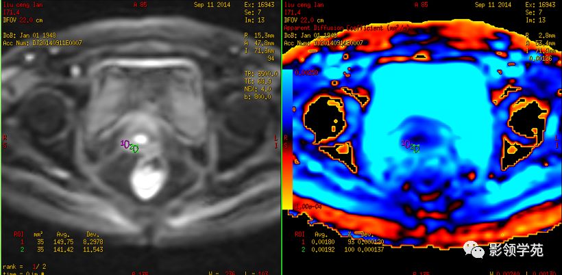 宫颈癌mri诊断,宫颈癌的mr扫描技术