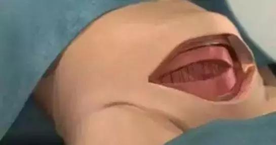 剖腹产要开7层吗,要剖之前孕妈妈该怎么做