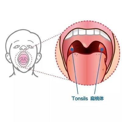 宝宝为什么会扁桃体化脓,为什么宝宝扁桃体容易发炎