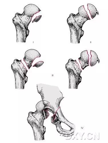 所有骨折都叫什么名字,骨折的名称有哪些