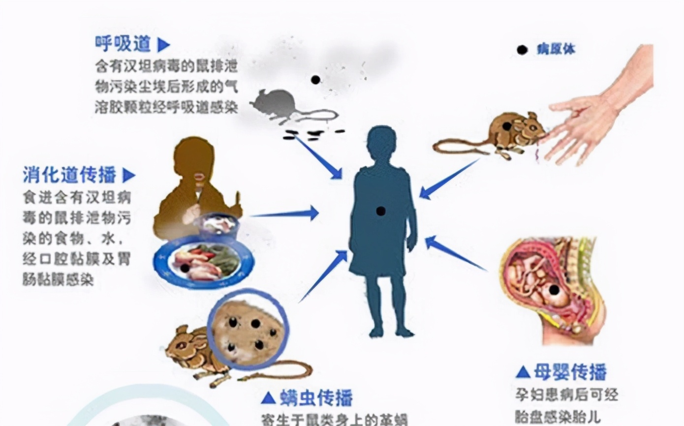 肾综合征出血热防治知识