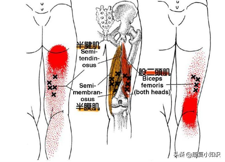 大腿后侧疼痛是癌症吗,大腿后侧疼痛有什么方法缓解