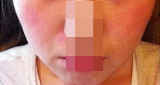 光子嫩肤敏感皮肤能做吗,光子嫩肤做了皮肤敏感