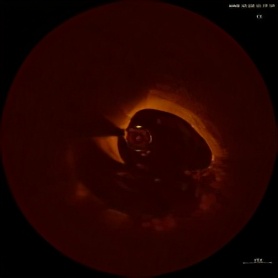 oct在冠脉介入的应用,广西冠脉介入治疗