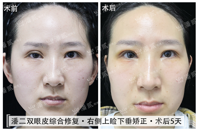 双眼皮术后恢复不一致正常吗,双眼皮术后看着不对称