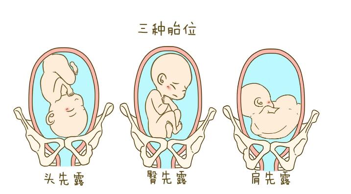 b超单上胎位怎么看,b超单怎么看胎位正确