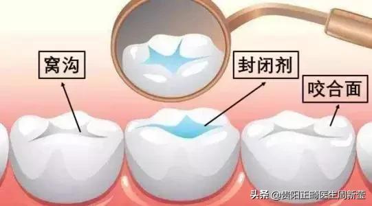 牙齿不好怪父母,儿童口腔不良习惯及矫正