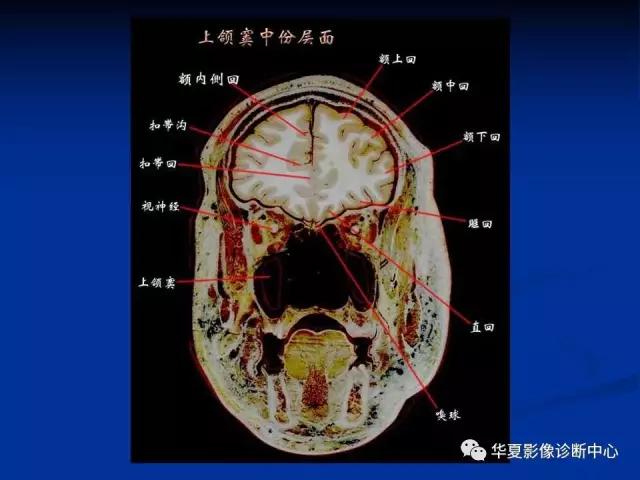 mra头颅解剖学详细讲解视频,常见的头颅mri图像