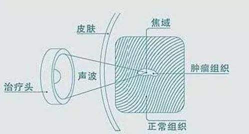 不开刀的子宫肌瘤消融术,不动手术做子宫肌瘤叫什么仪器