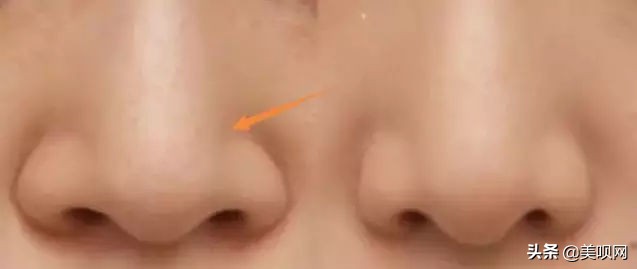 哪个明星做了鼻翼缩小手术,金南珠鼻翼缩小手术