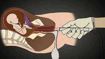 堕胎到底有没有恶果,堕胎真的那么可怕吗