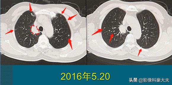 三种情况发现是肺癌晚期,晚期肺癌不咳嗽爱睡觉是怎么回事