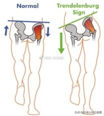 髌股关节疼痛综合征治疗,髌股疼痛综合征如何诊断