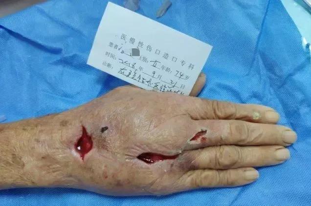 挤痘痘引发脑膜炎几率,挤痘痘会引发囊肿吗