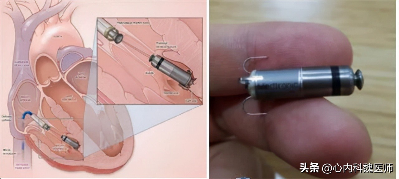心电图显示窦性心动过缓怎么回事,心电图查出窦性心动过缓严重吗