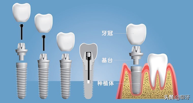 牙齿需要种植牙会经历几个步骤,种植牙流程什么情况需要做骨粉