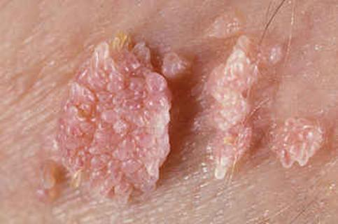 男性尖锐性湿疣自愈一年没有复发,尖锐性湿疣患者的治愈经历经验