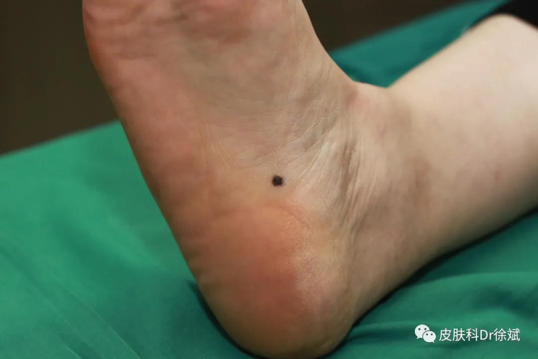 脚底所有黑痣都得切除吗,16岁脚底板长了黑痣一定要切除吗