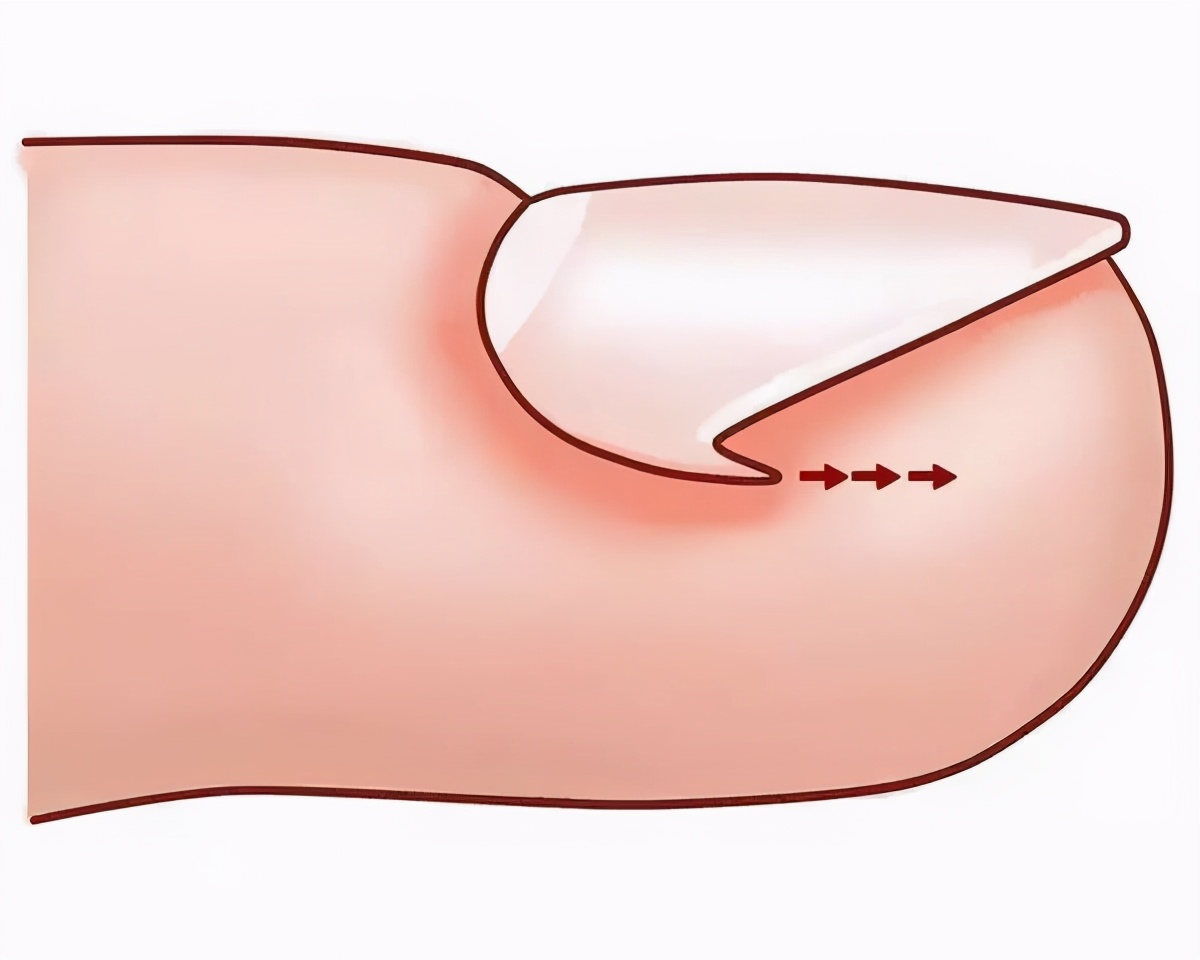 得了甲沟炎有什么关注事项,甲沟炎不是很严重时应该怎么办