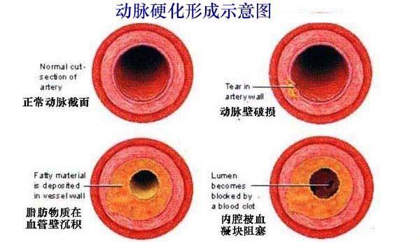 60岁动脉硬化的原因及解决办法,60岁有动脉硬化怎么治疗