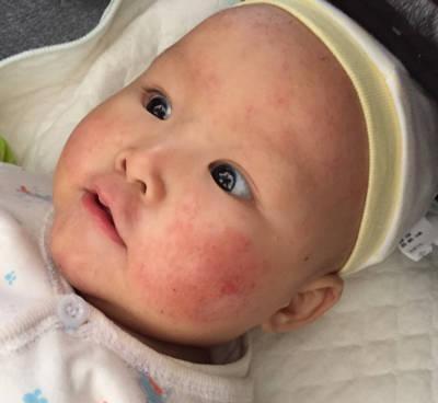 宝宝是过敏体质有必要查过敏源吗,容易长湿疹的宝宝是过敏体质吗