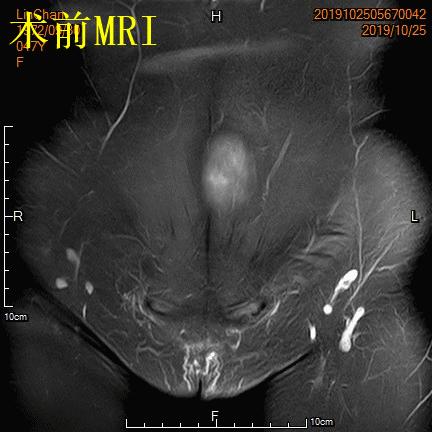 子宫腺肌症称为不死的癌症,子宫腺肌症是不死的癌症吗