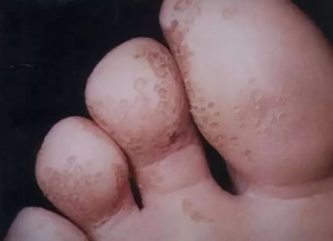 脚臭一定有狐臭么,脚臭能臭到什么程度