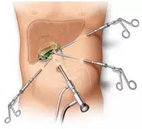 胆囊息肉会癌变吗？听医生的，医生说了算