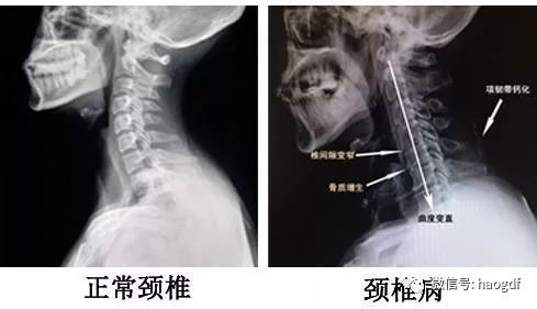 颈椎病千万别做这动作,颈椎病患者千万不要做这个动作