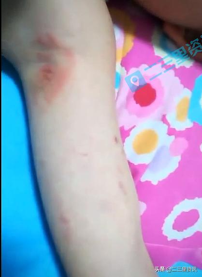 孩子胳膊有一片红色淤青不疼,孩子胳膊上有一片红色印子