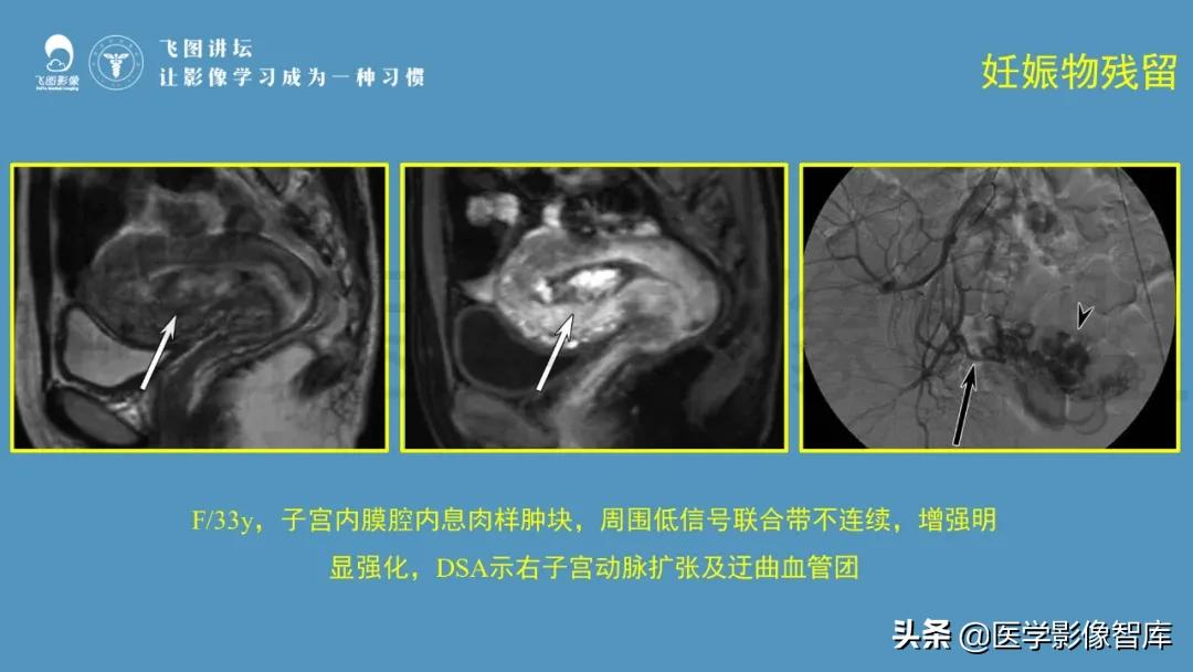 子宫解剖结构输卵管和卵巢位置,子宫附件ct影像学正常解剖表现