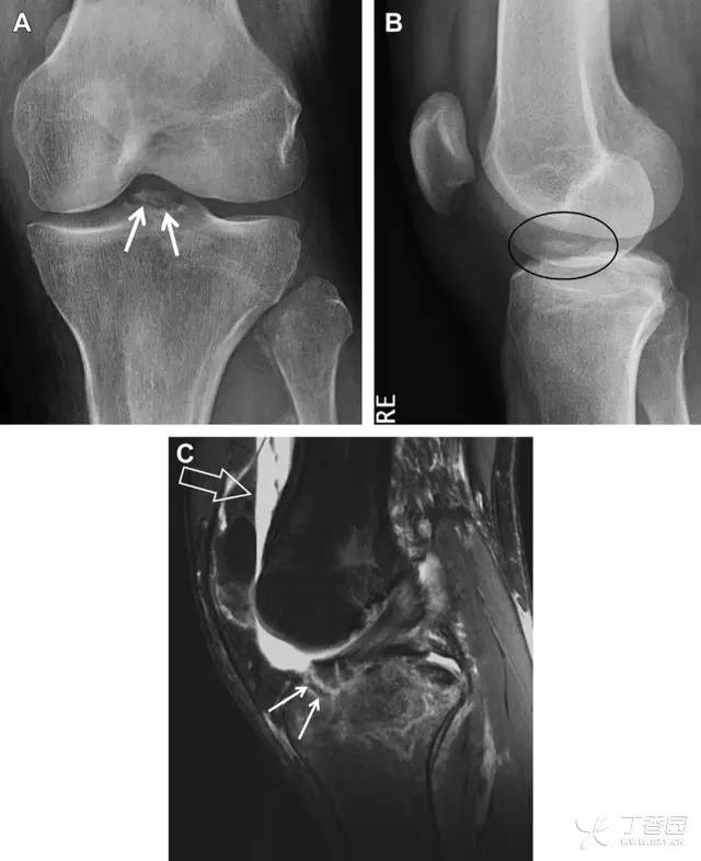 常见的八种骨折,容易漏诊的肩关节骨折