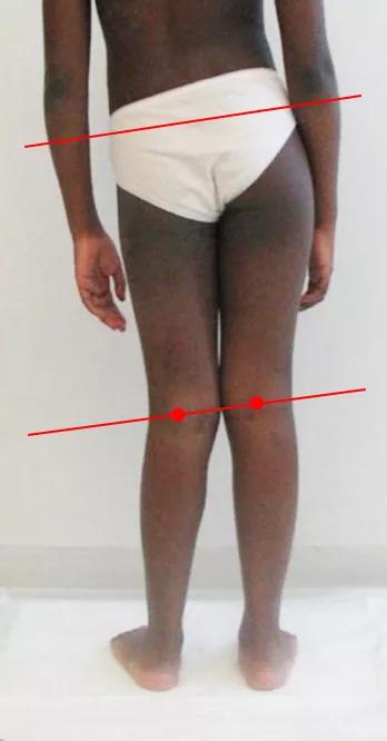 双脚外侧鞋底磨损严重,双脚鞋底磨损程度不同