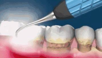 洗牙会不会使牙缝变大呢,洗牙会使牙齿松动牙缝变大吗