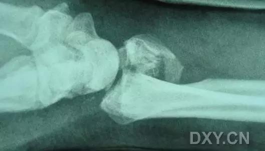 所有骨折都叫什么名字,骨折的名称有哪些