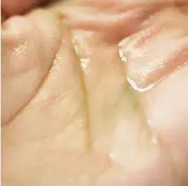 发际线后移的头发还能长出来么,头发发际线高还能长出来吗