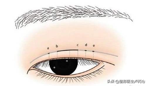 韩式三点双眼皮属于微创吗,韩式微创翘睫双眼皮