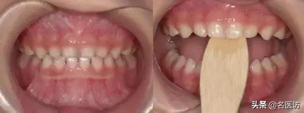 地包天早期矫正最佳时间,地包天最佳矫正时间及方法