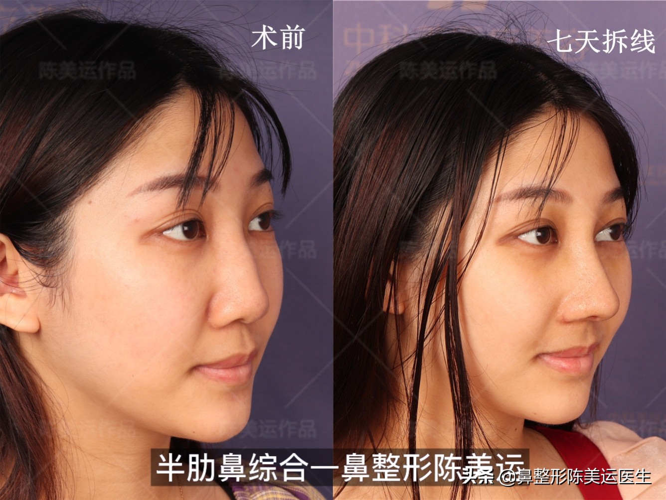 线雕隆鼻失败的图片,线雕隆鼻失败