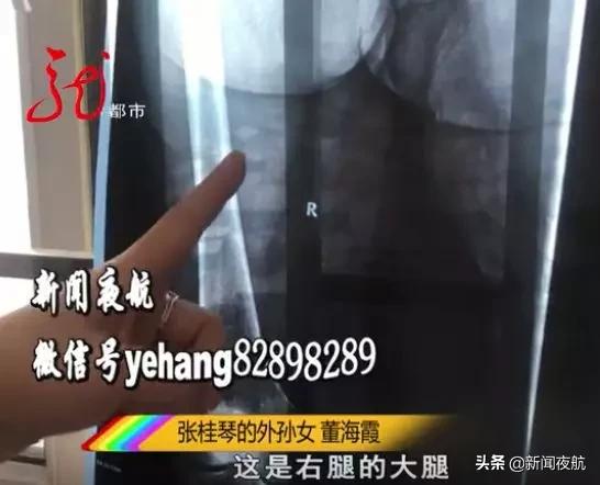 80岁老人股骨置换术后怎样做护理,80岁老人股骨头置换术后恢复