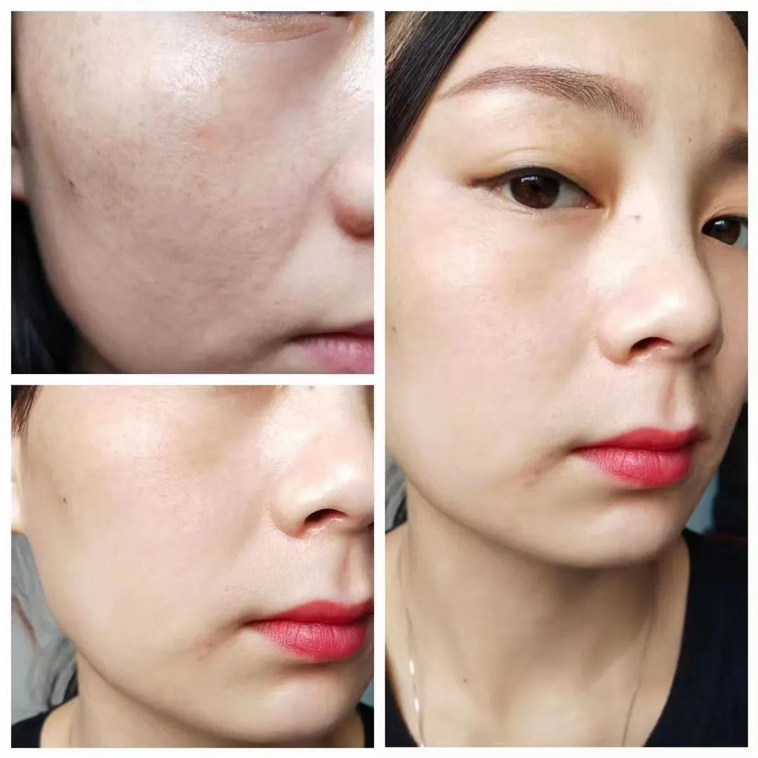 甜甜专业祛斑祛痘,甜甜祛斑直播间