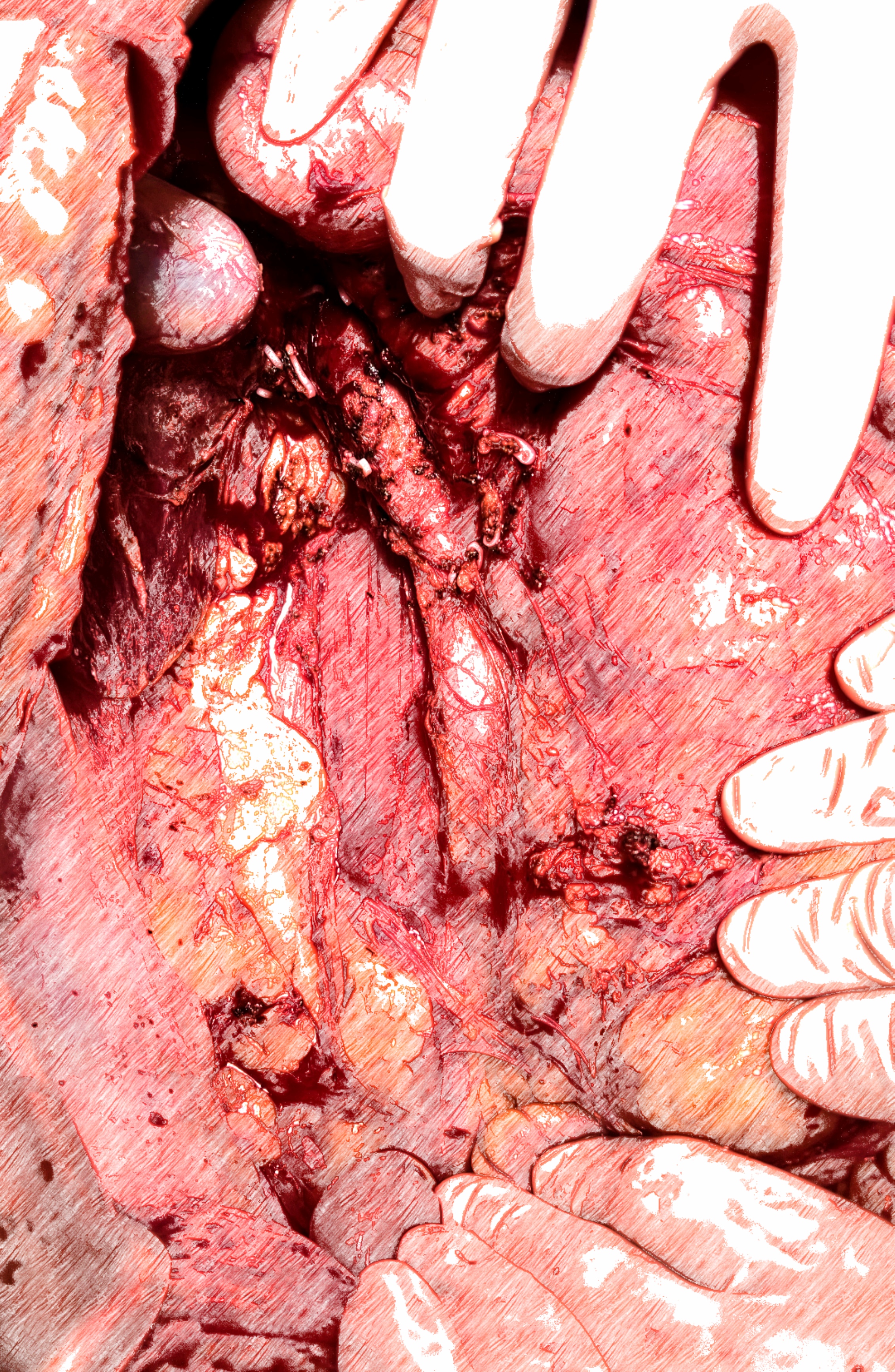 泌尿肿瘤mdt是什么意思,泌尿系肿瘤mdt专家共识